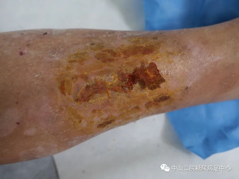 伤口负压治疗怎么收费54天，治愈一例小腿胫前溃疡的糖尿病病人！_https://www.jmylbn.com_新闻资讯_第17张