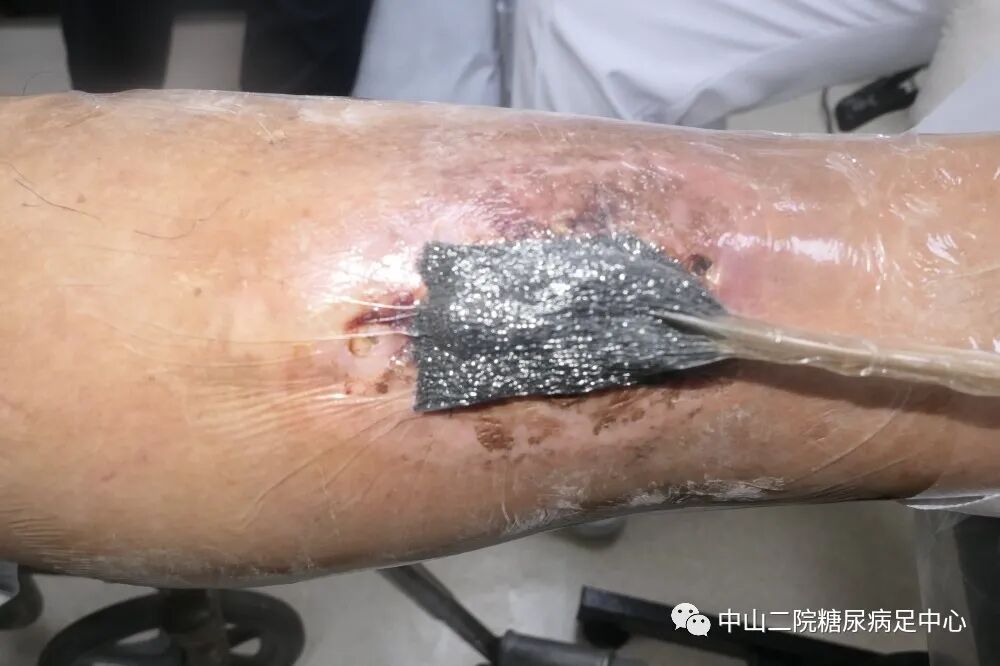 伤口负压治疗怎么收费54天，治愈一例小腿胫前溃疡的糖尿病病人！_https://www.jmylbn.com_新闻资讯_第6张