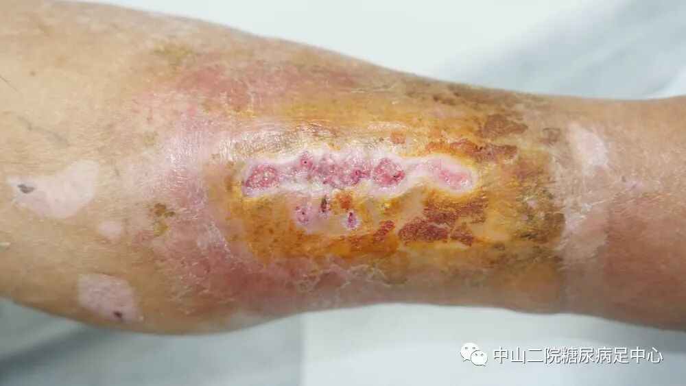 伤口负压治疗怎么收费54天，治愈一例小腿胫前溃疡的糖尿病病人！_https://www.jmylbn.com_新闻资讯_第16张