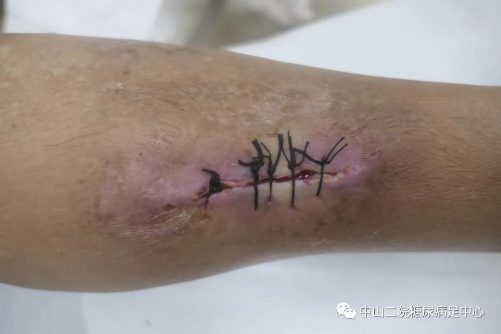 伤口负压治疗怎么收费54天，治愈一例小腿胫前溃疡的糖尿病病人！_https://www.jmylbn.com_新闻资讯_第9张