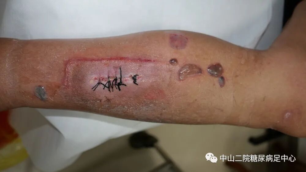 伤口负压治疗怎么收费54天，治愈一例小腿胫前溃疡的糖尿病病人！_https://www.jmylbn.com_新闻资讯_第11张