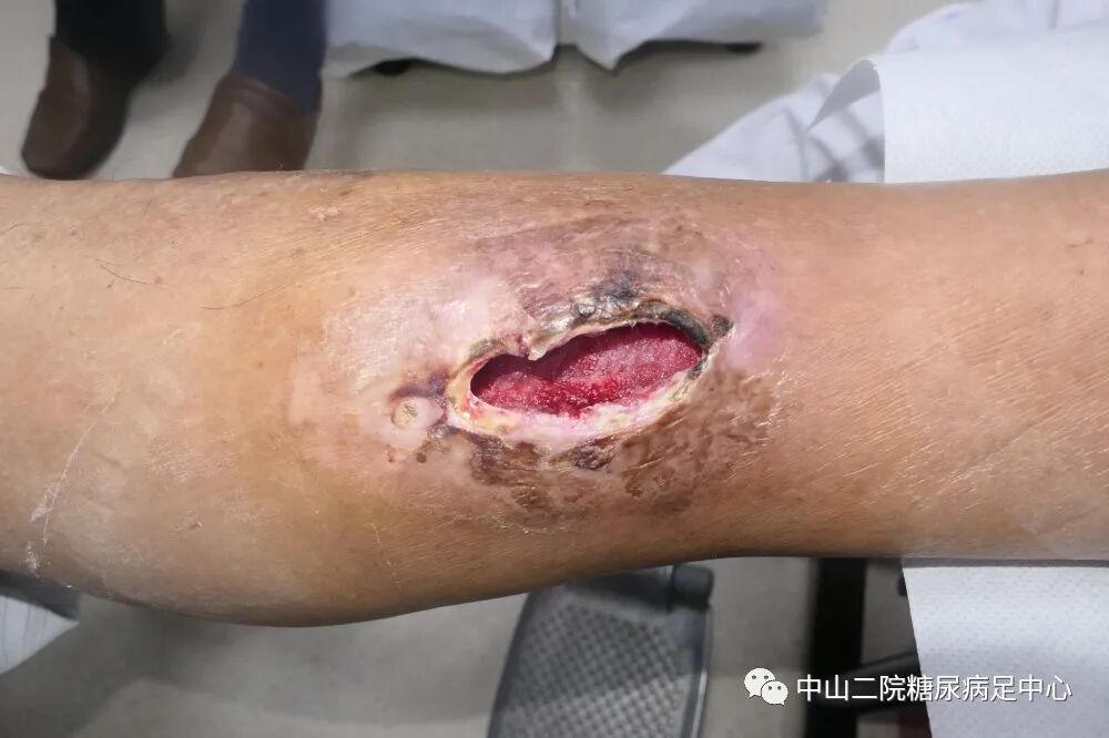 伤口负压治疗怎么收费54天，治愈一例小腿胫前溃疡的糖尿病病人！_https://www.jmylbn.com_新闻资讯_第5张