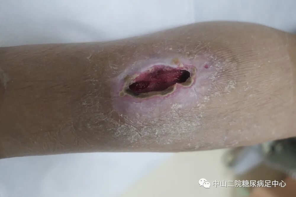 伤口负压治疗怎么收费54天，治愈一例小腿胫前溃疡的糖尿病病人！_https://www.jmylbn.com_新闻资讯_第7张