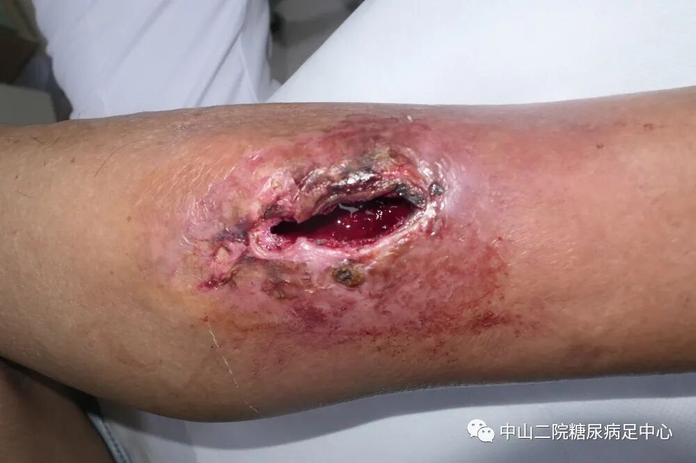 伤口负压治疗怎么收费54天，治愈一例小腿胫前溃疡的糖尿病病人！_https://www.jmylbn.com_新闻资讯_第4张