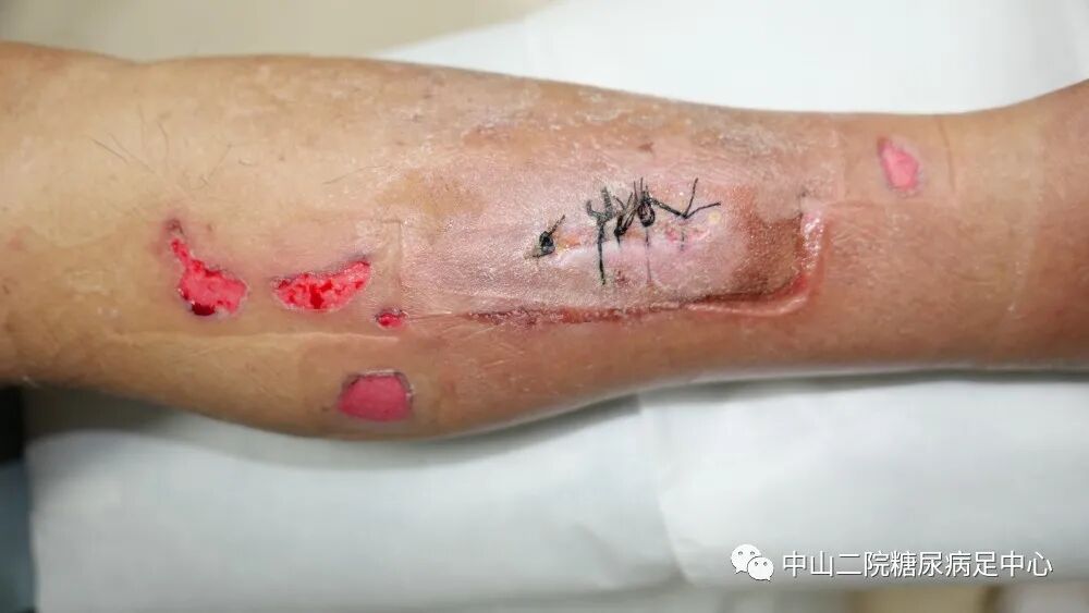 伤口负压治疗怎么收费54天，治愈一例小腿胫前溃疡的糖尿病病人！_https://www.jmylbn.com_新闻资讯_第13张
