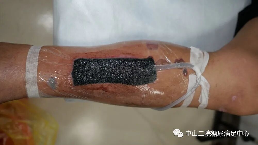 伤口负压治疗怎么收费54天，治愈一例小腿胫前溃疡的糖尿病病人！_https://www.jmylbn.com_新闻资讯_第10张