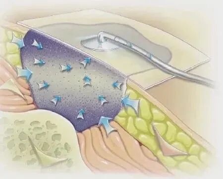 为什么负压引流“露骨”压疮碗口大，“负压”引流终治愈！_https://www.jmylbn.com_新闻资讯_第2张