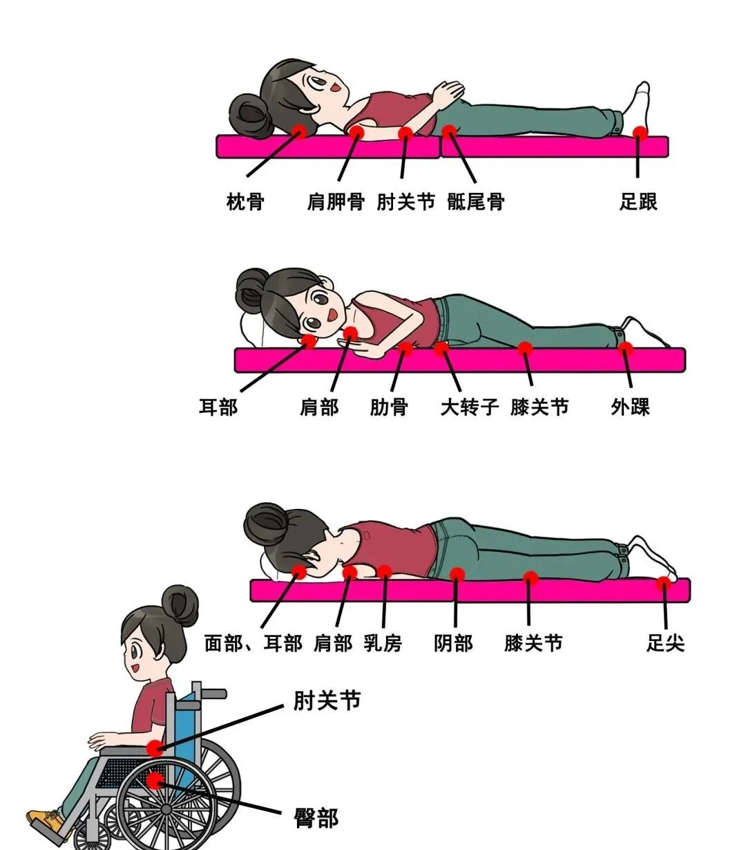 为什么负压引流“露骨”压疮碗口大，“负压”引流终治愈！_https://www.jmylbn.com_新闻资讯_第5张