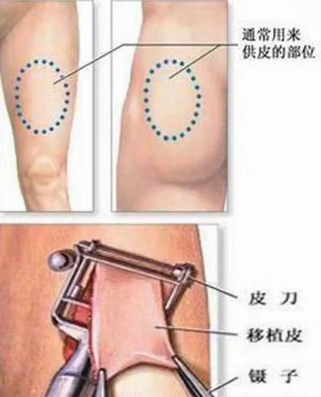 vsd引流怎么拔出新技术新项目｜VSD技术与游离皮片移植术的“双剑合璧”_https://www.jmylbn.com_新闻资讯_第3张