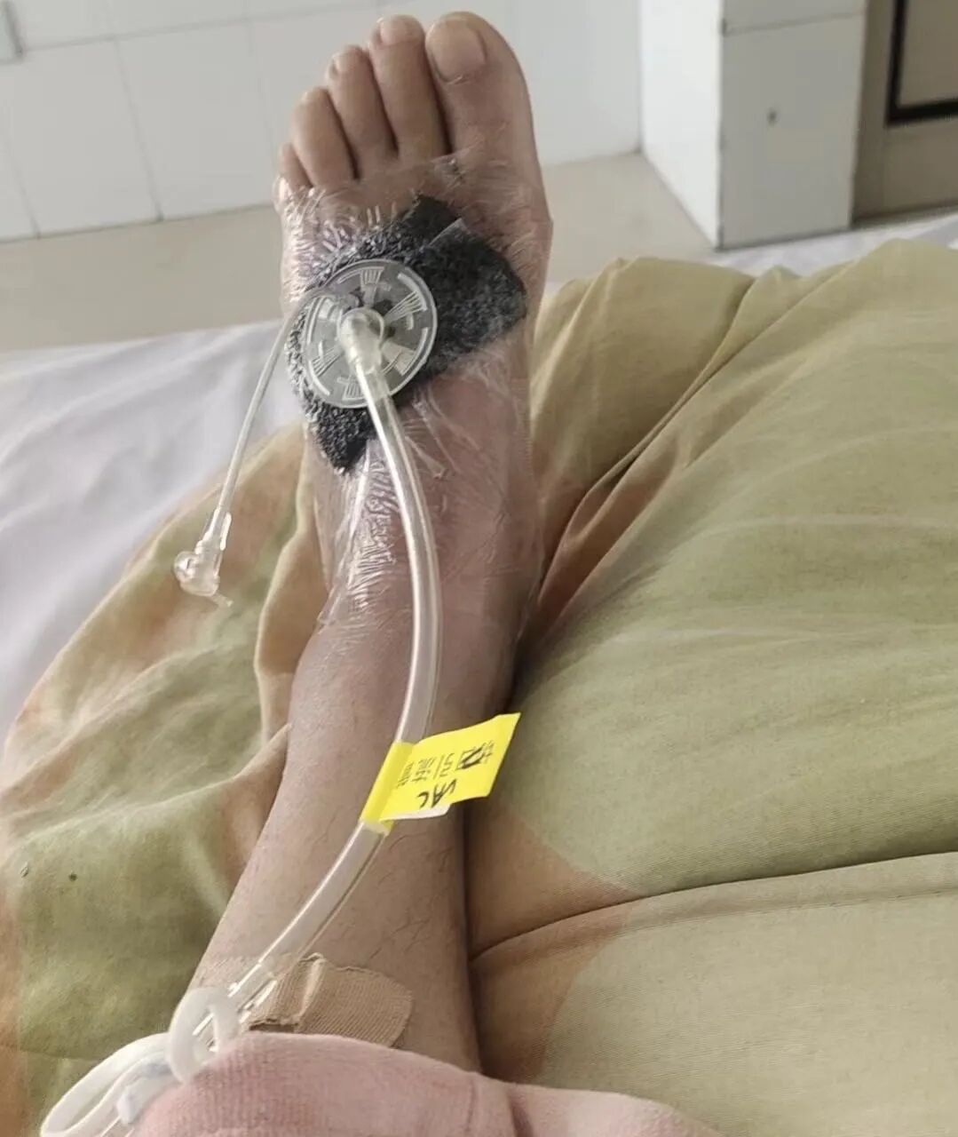 vsd引流怎么拔出新技术新项目｜VSD技术与游离皮片移植术的“双剑合璧”_https://www.jmylbn.com_新闻资讯_第1张