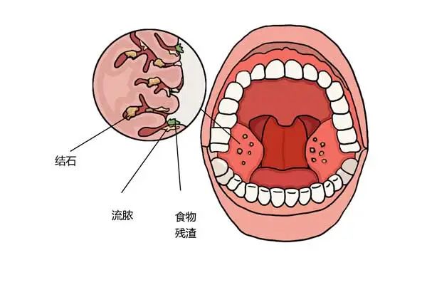 扁桃体结石在哪儿图片