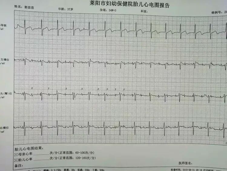 胎儿心电图是什么意思胎儿心电图：解读宝宝的健康密码，珍藏最初的心动瞬间_https://www.jmylbn.com_新闻资讯_第3张