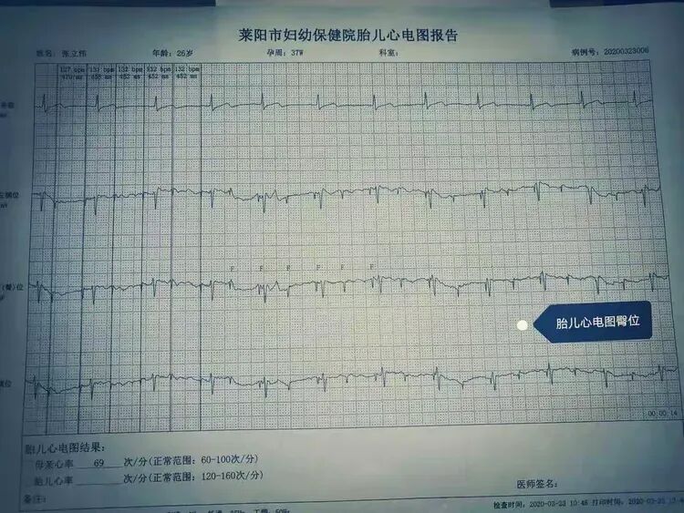 胎儿心电图是什么意思胎儿心电图：解读宝宝的健康密码，珍藏最初的心动瞬间_https://www.jmylbn.com_新闻资讯_第2张