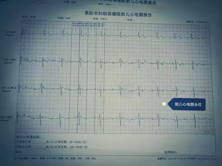 胎儿心电图是什么意思胎儿心电图：解读宝宝的健康密码，珍藏最初的心动瞬间_https://www.jmylbn.com_新闻资讯_第1张