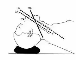 气管插管导丝有什么用健康科普 ｜ 气管插管的那些事儿_https://www.jmylbn.com_新闻资讯_第4张