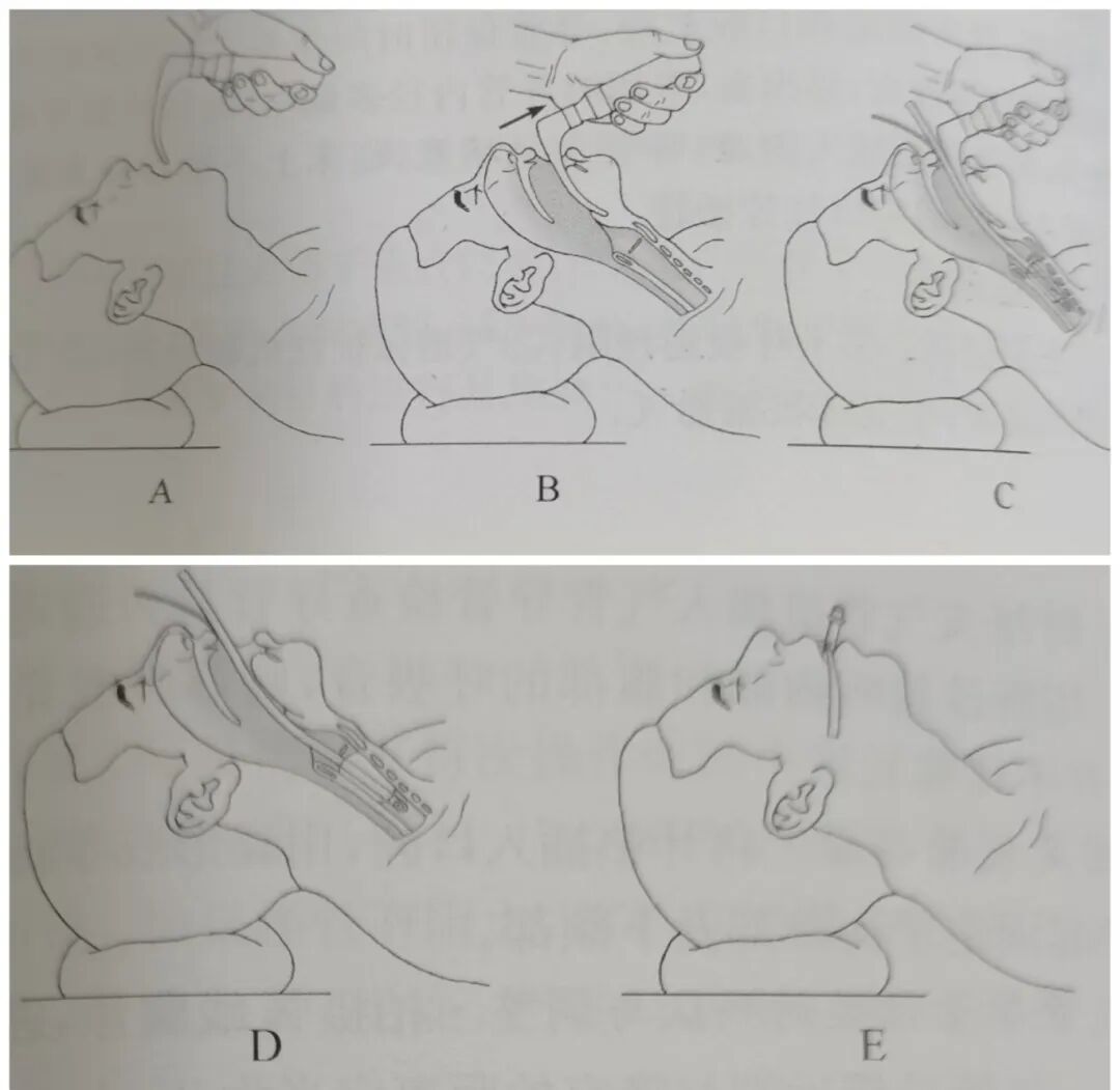 气管插管导丝有什么用健康科普 ｜ 气管插管的那些事儿_https://www.jmylbn.com_新闻资讯_第6张