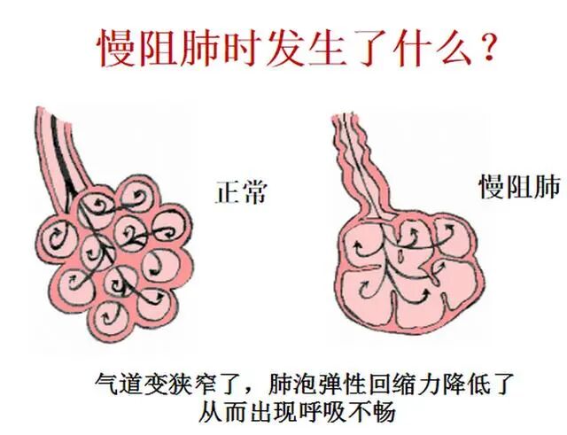 呼吸机怎么制氧知识科普｜“呼吸机”和“制氧机”有哪些区别？_https://www.jmylbn.com_新闻资讯_第19张