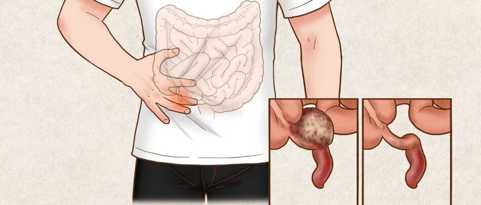 经方三辨——大黄牡丹皮汤（中医大家叶橘泉经验）