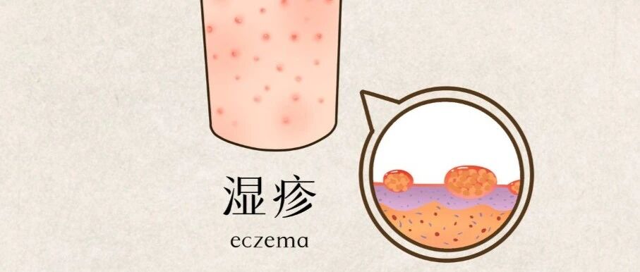 治成人湿疹验方5则