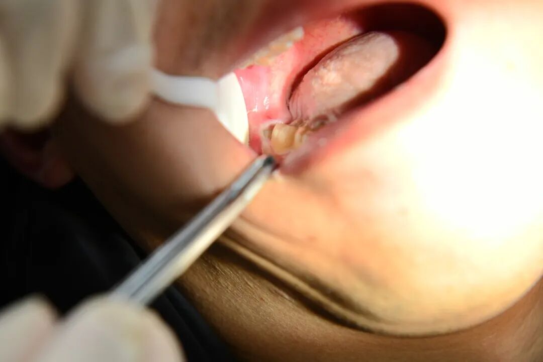 牙科骨凿怎么用嘴里那颗“智齿”到底要不要拔？纠结100次不如听牙科医生说一回_https://www.jmylbn.com_新闻资讯_第16张