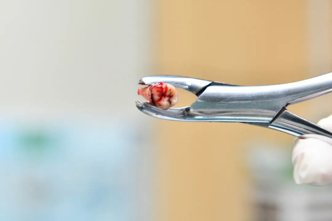 牙科骨凿怎么用嘴里那颗“智齿”到底要不要拔？纠结100次不如听牙科医生说一回_https://www.jmylbn.com_新闻资讯_第14张