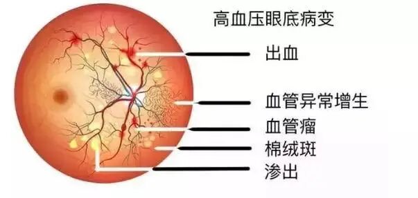 彩色眼底照相查什么拍一张眼底照片，就能帮你查清全身问题！_https://www.jmylbn.com_新闻资讯_第9张