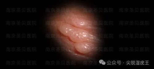 康复治疗激光怎么收费临床实录：女性外阴丶宫颈尖锐湿疣康复案例（激光、光动力治疗复发）_https://www.jmylbn.com_新闻资讯_第3张