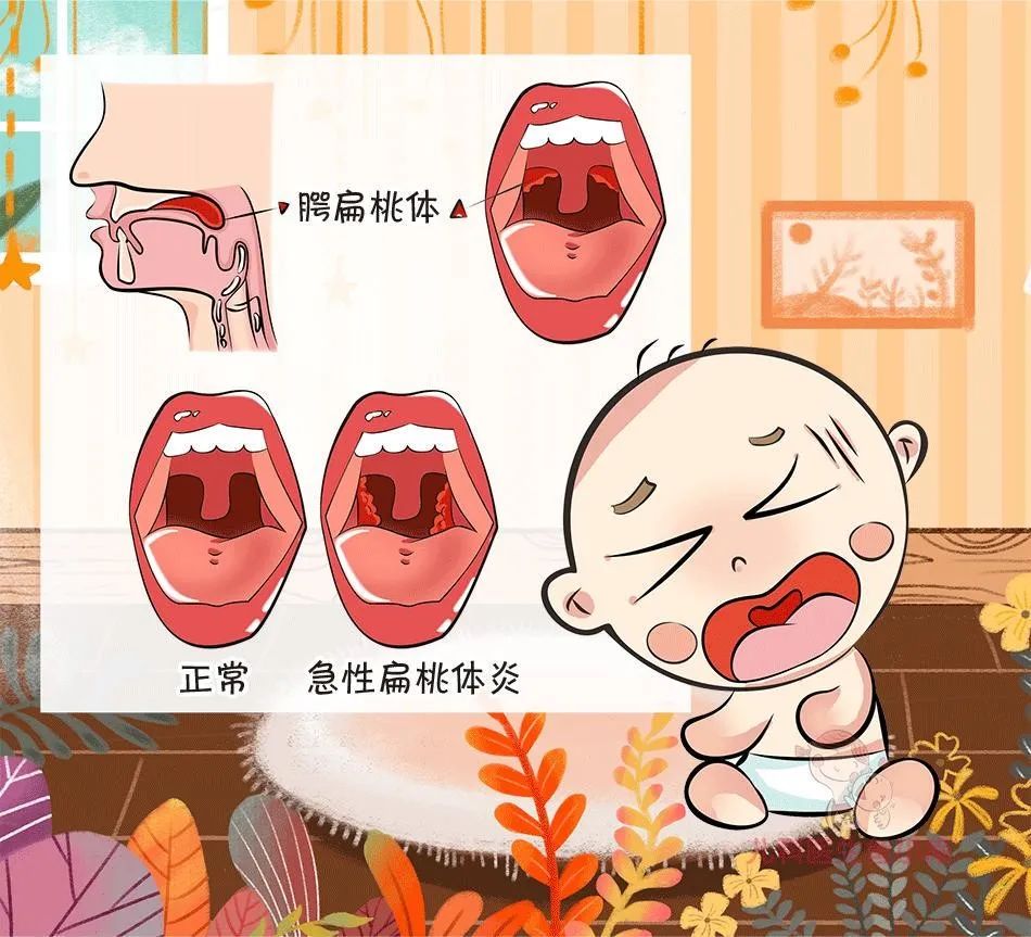 扁桃体怎么治疗