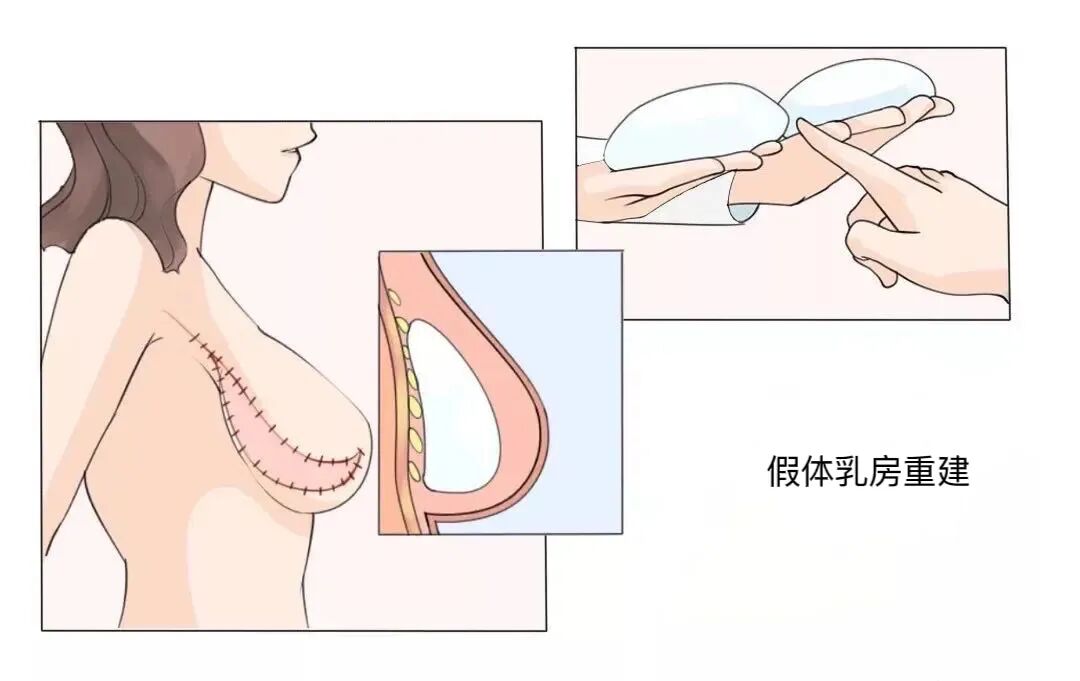 压力绷带为什么那么贵乳腺癌术后『乳房重建』让安全与美丽并存_https://www.jmylbn.com_新闻资讯_第5张