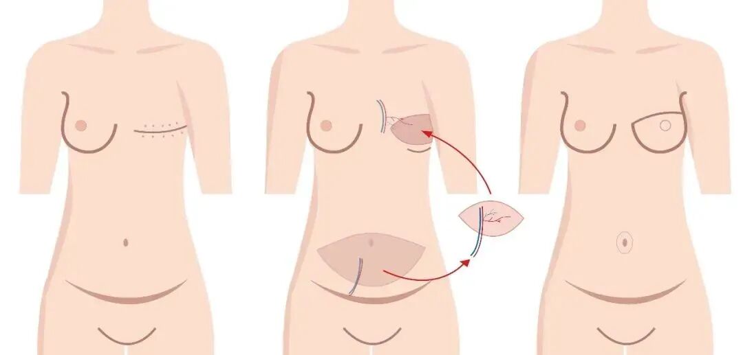 压力绷带为什么那么贵乳腺癌术后『乳房重建』让安全与美丽并存_https://www.jmylbn.com_新闻资讯_第7张