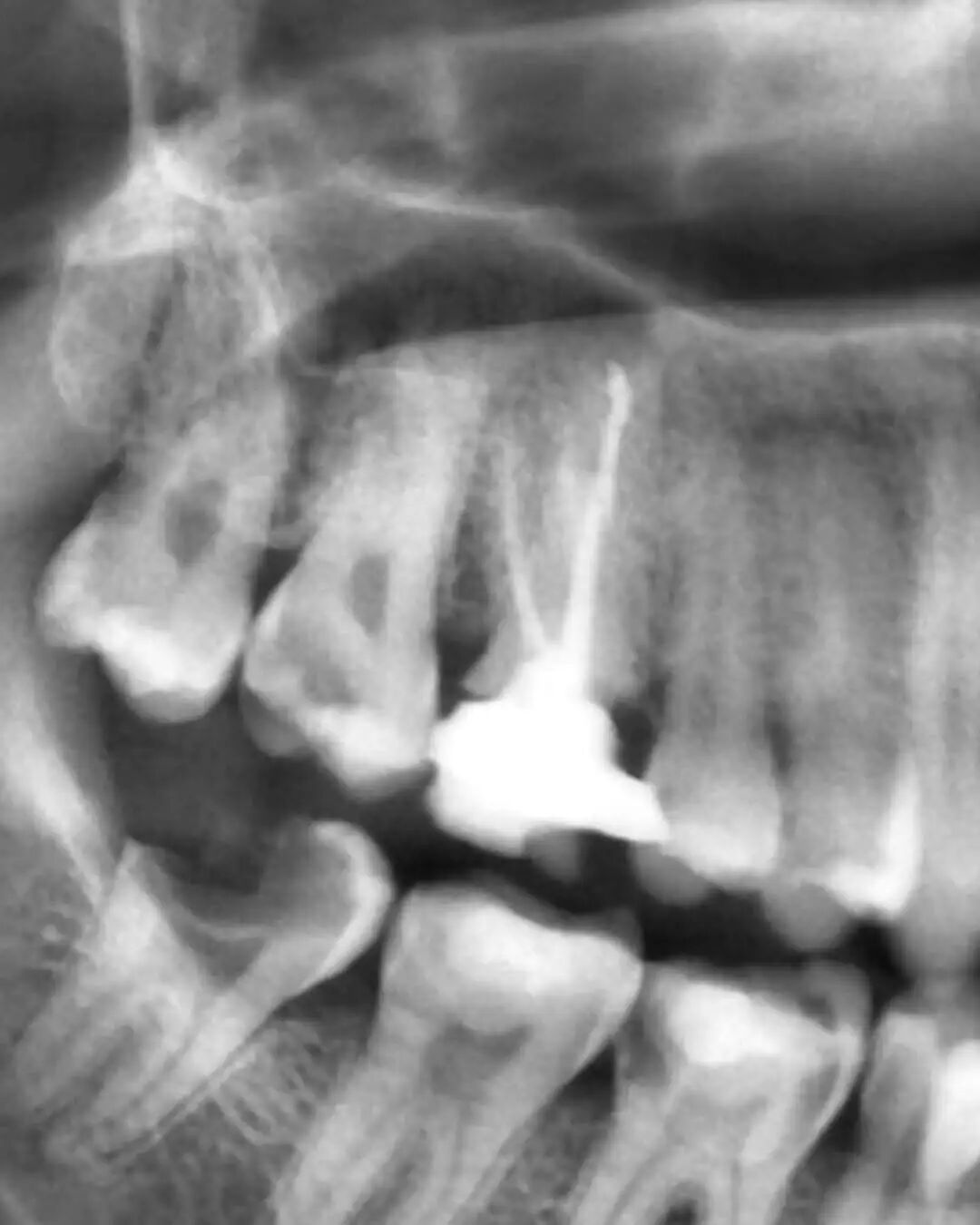 看伊朗牙体大夫的一例根管再治疗