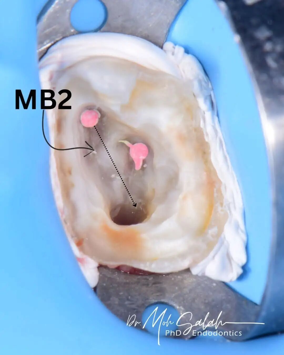 看伊朗牙体大夫的一例根管再治疗