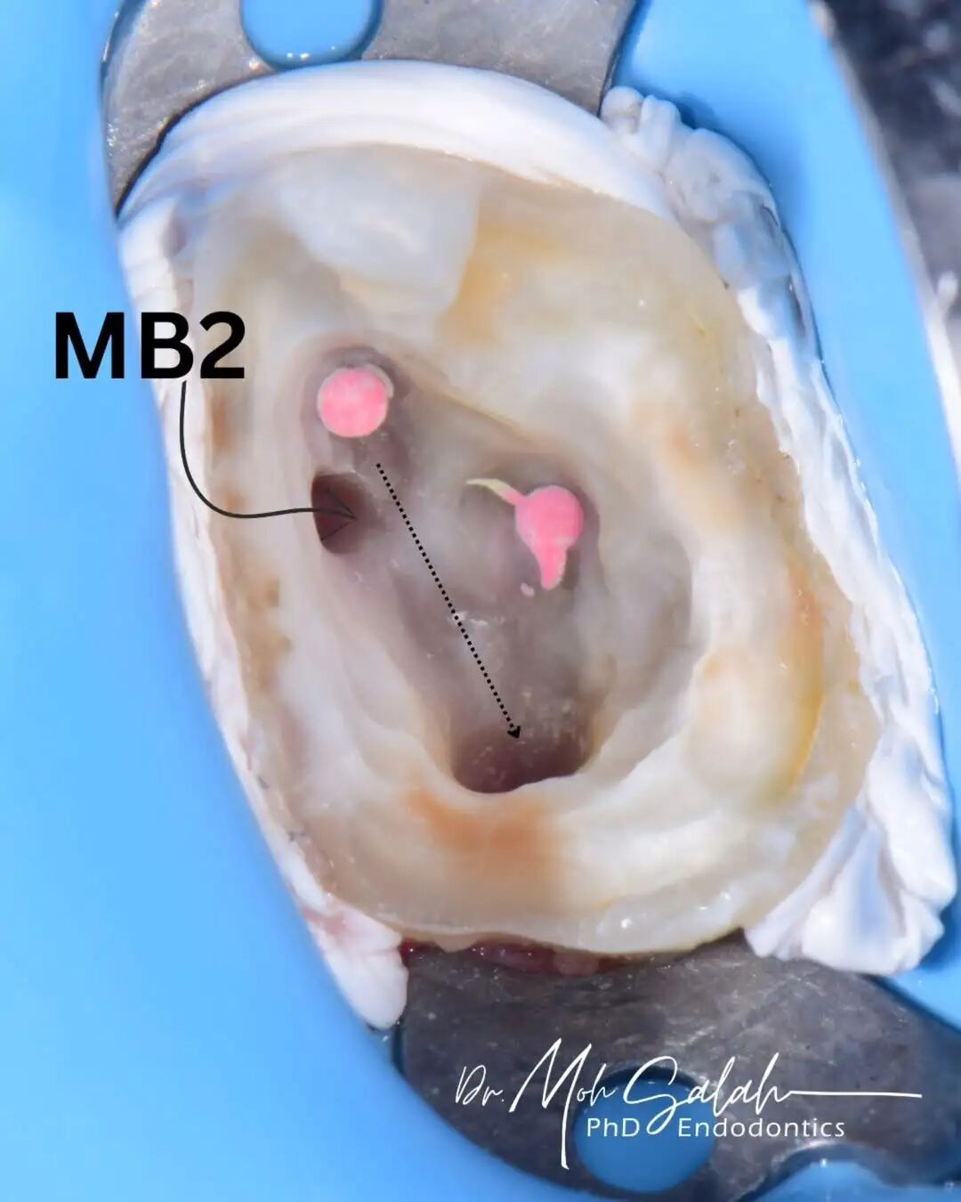 看伊朗牙体大夫的一例根管再治疗