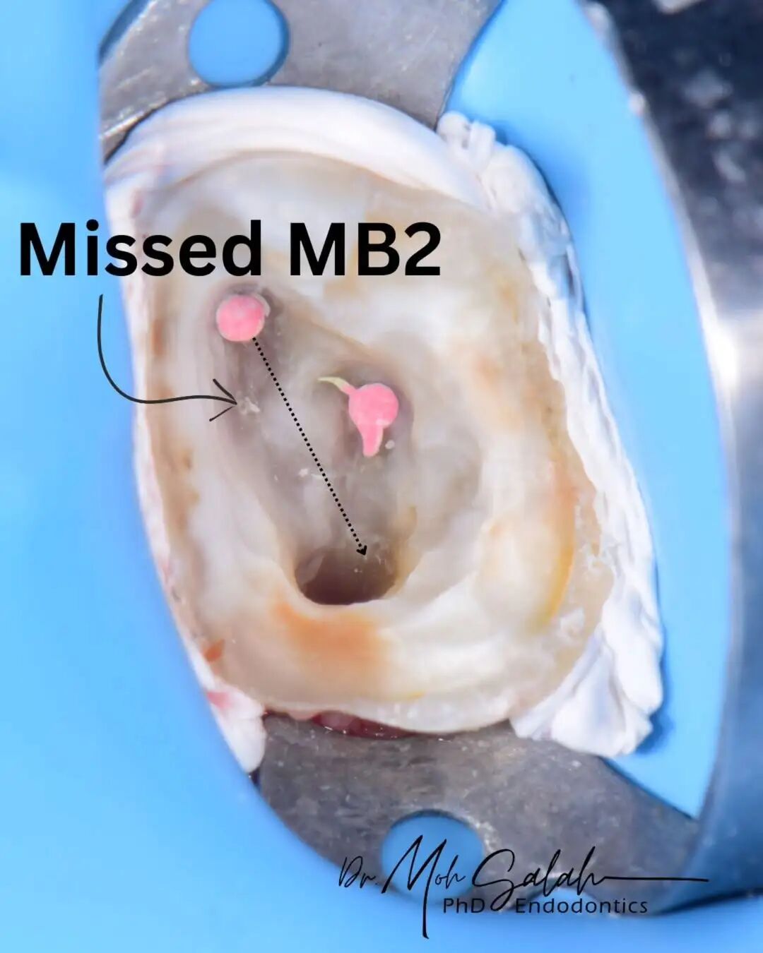 看伊朗牙体大夫的一例根管再治疗