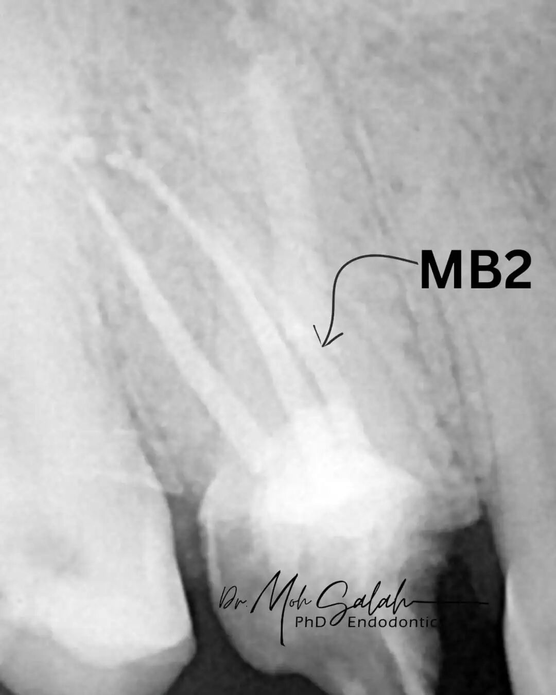 看伊朗牙体大夫的一例根管再治疗