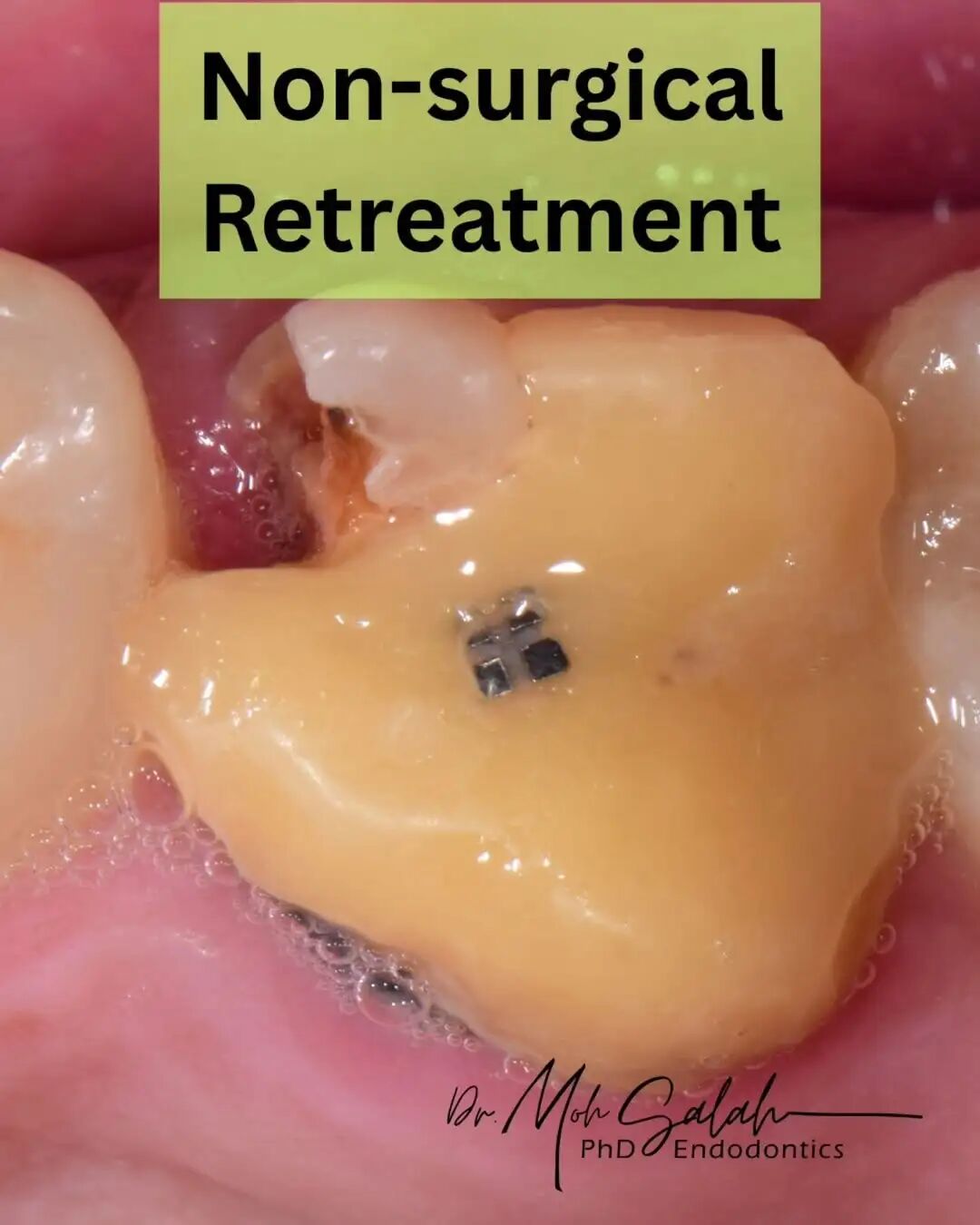 看伊朗牙体大夫的一例根管再治疗