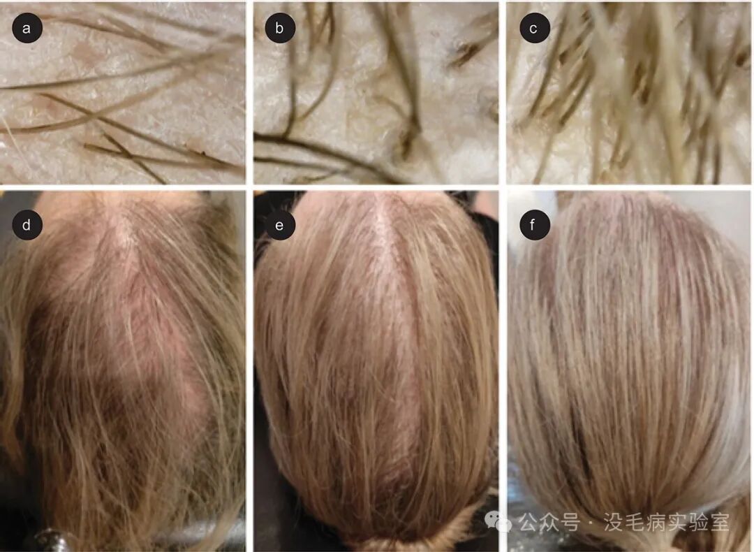 皮肤病学时报：剖析女性脱发的原因并探索防治措施