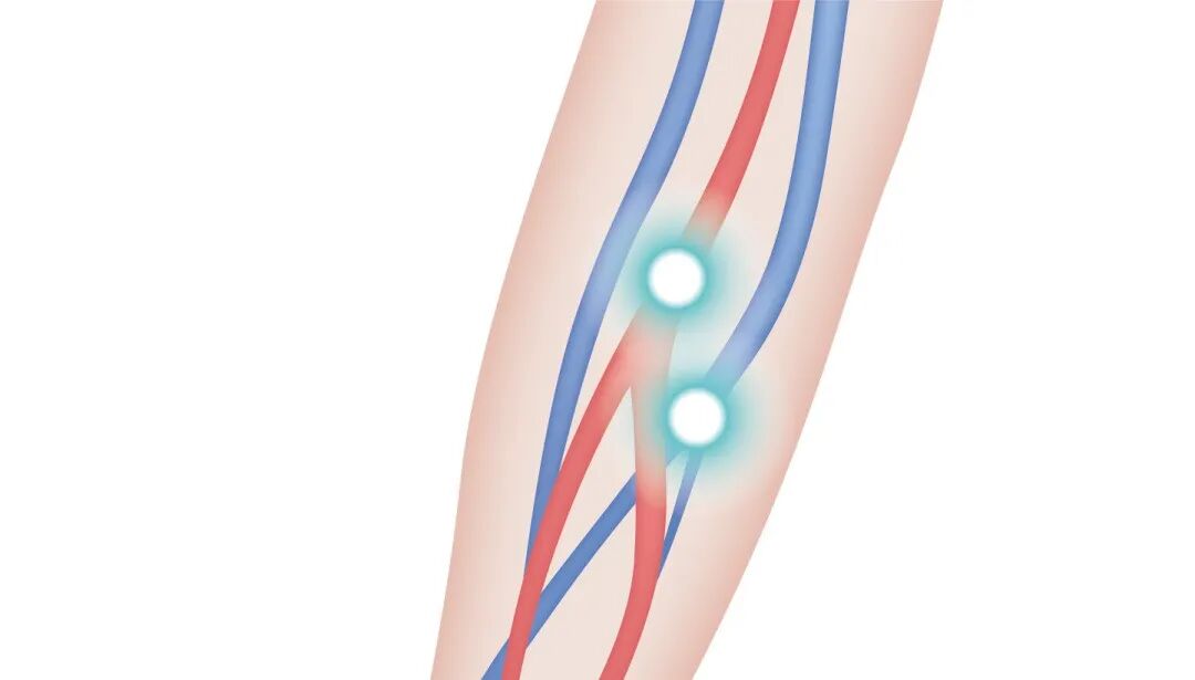 止血贴怎么贴内瘘止血新方法！你get到了吗？_https://www.jmylbn.com_新闻资讯_第7张