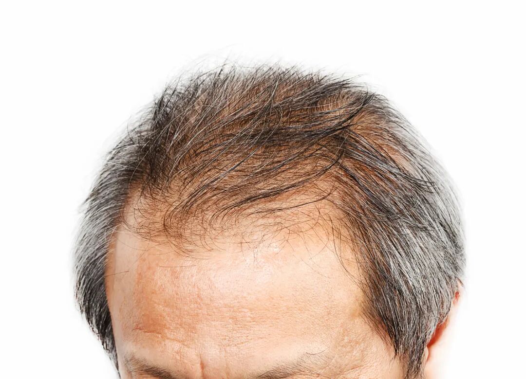 千库网_头发损失症状男性头部正面._摄影图编号20151833.jpg