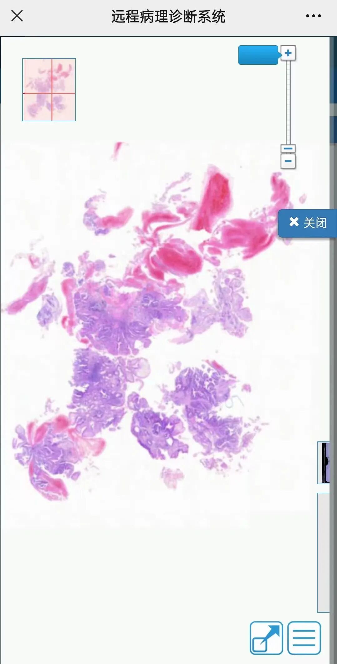 口镜怎么微创中的微创——ERCP引导下的经口胆道镜技术_https://www.jmylbn.com_新闻资讯_第5张
