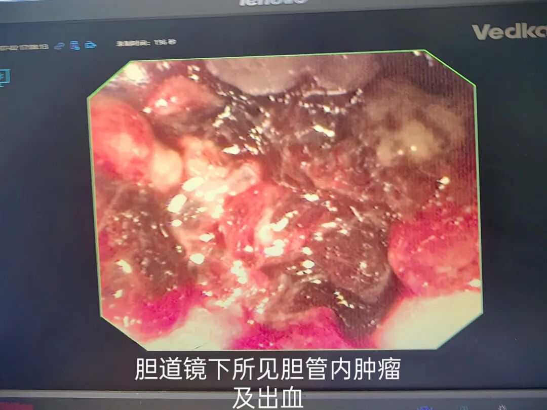 口镜怎么微创中的微创——ERCP引导下的经口胆道镜技术_https://www.jmylbn.com_新闻资讯_第4张