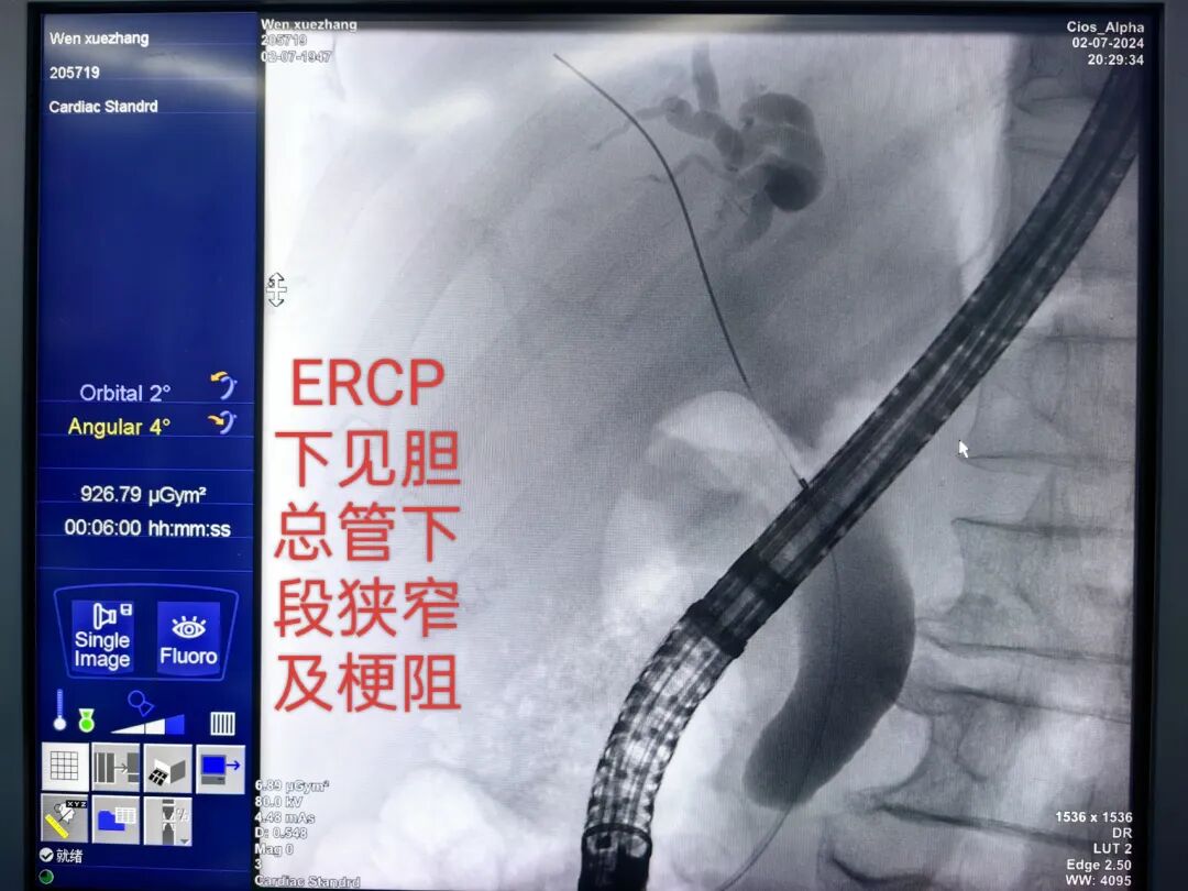 口镜怎么微创中的微创——ERCP引导下的经口胆道镜技术_https://www.jmylbn.com_新闻资讯_第2张