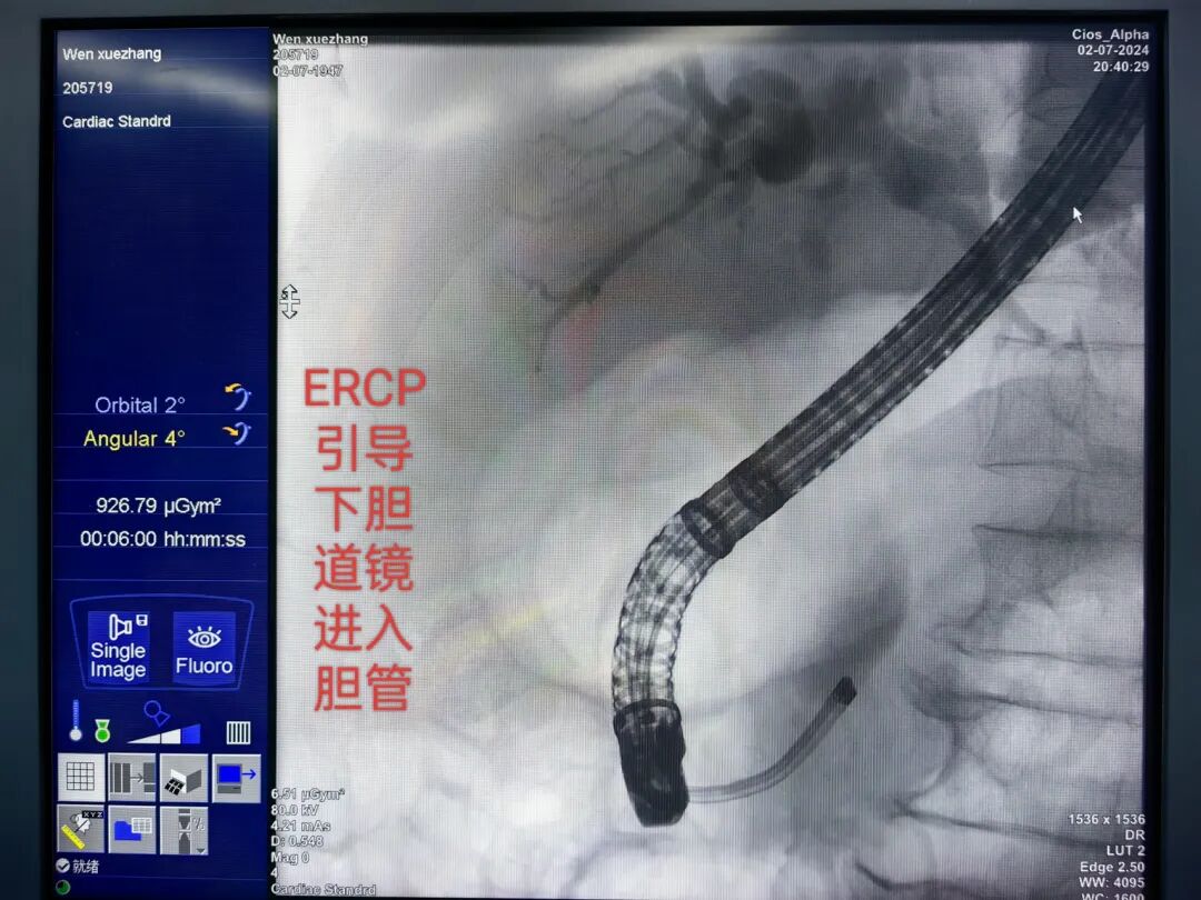 口镜怎么微创中的微创——ERCP引导下的经口胆道镜技术_https://www.jmylbn.com_新闻资讯_第3张