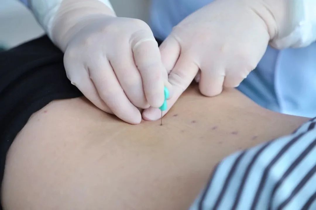 八一医院外科疼痛特色疗法——小针刀
