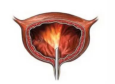 b膀胱镜为什么消毒口袋指南｜膀胱镜检查需要注意这些_https://www.jmylbn.com_新闻资讯_第3张