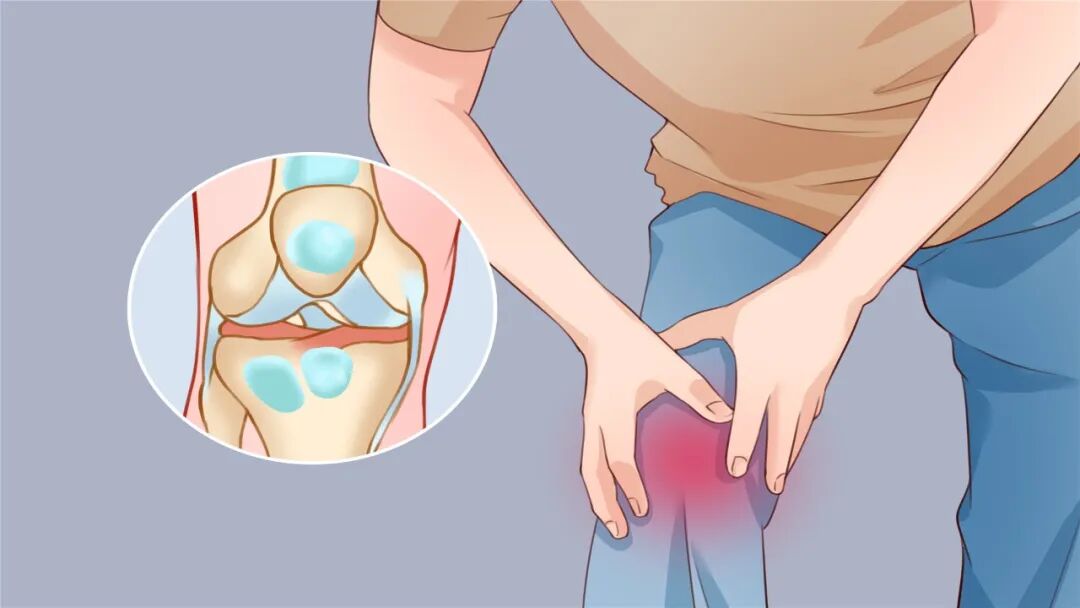 为什么买关节镜膝盖“咔咔响”、上下楼疼？一文读懂膝骨关节炎，不是“老寒腿”那么简单！_https://www.jmylbn.com_新闻资讯_第3张