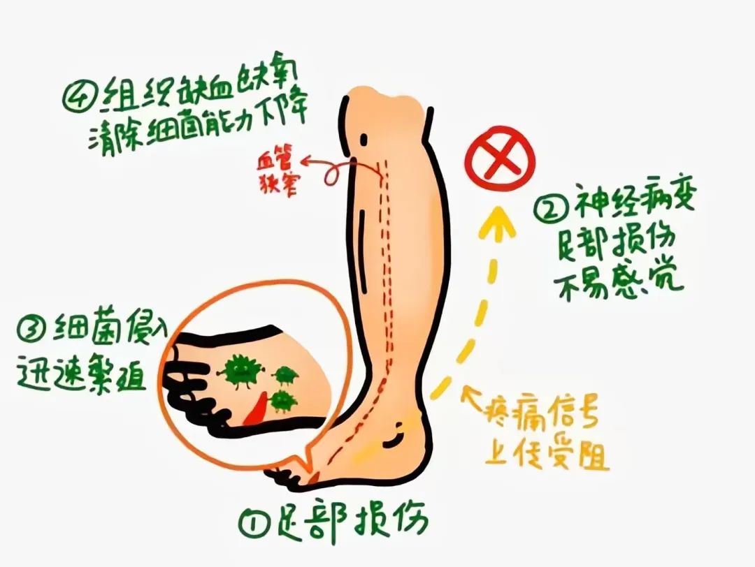 【人医科普】认识糖尿病足:预防和治疗并重