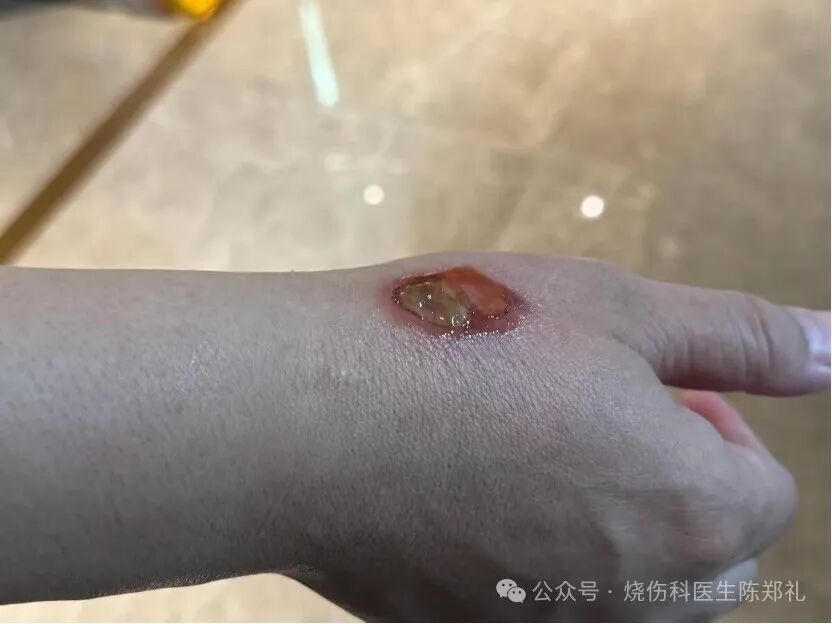 烧伤敷料怎么用图解创面外用药物及敷料系列丨油性药膏的原理及注意事项_https://www.jmylbn.com_新闻资讯_第5张