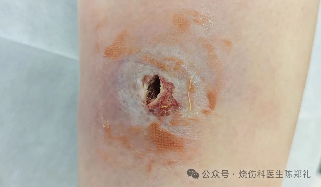 烧伤敷料怎么用图解创面外用药物及敷料系列丨油性药膏的原理及注意事项_https://www.jmylbn.com_新闻资讯_第12张