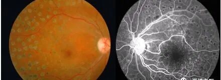 眼底照相有什么用眼底照相仪——有效检测糖尿病、高血压等疾病的视网膜病变_https://www.jmylbn.com_新闻资讯_第6张